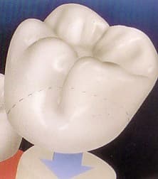 Ceramic dental crown on a prepared tooth
