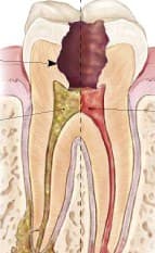Illustration of a root canal treatment on a molar