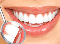 Professional dental scaling and polishing